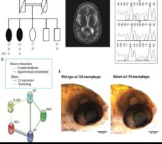 شناسایی یک ژن جدید در بیماری پارکینسون توسط محقق دانشگاه علوم پزشکی گلستان به همراه تیم تحقیقاتی
