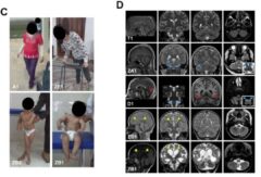 شناسایی یک ژن جدید در یک نوع معلولیت حرکتی شدید با مشارکت محقق دانشگاه علوم پزشکی گلستان